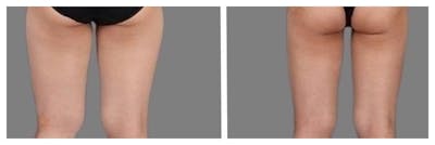 Liposuction Before & After Gallery - Patient 927902 - Image 1