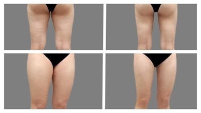 Liposuction Before & After Gallery - Patient 428325 - Image 1