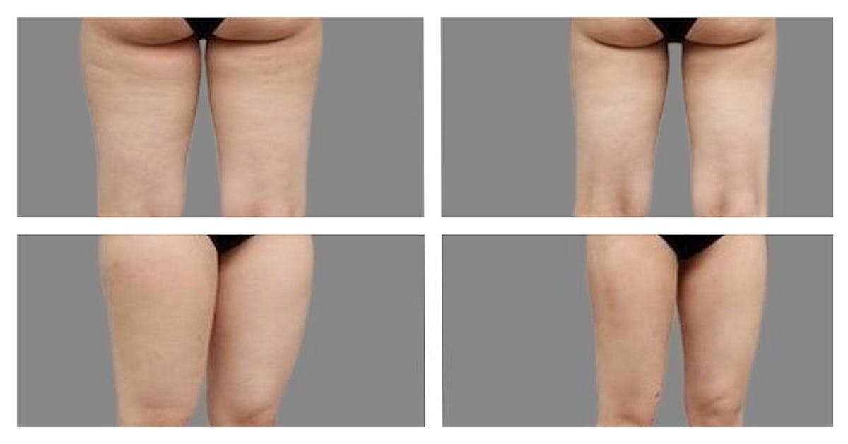 Liposuction Before & After Gallery - Patient 103229 - Image 1