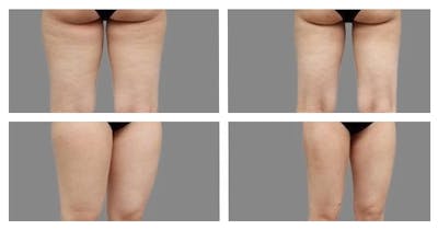 Liposuction Before & After Gallery - Patient 103229 - Image 1