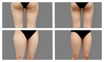 Liposuction Before & After Gallery - Patient 167990 - Image 1