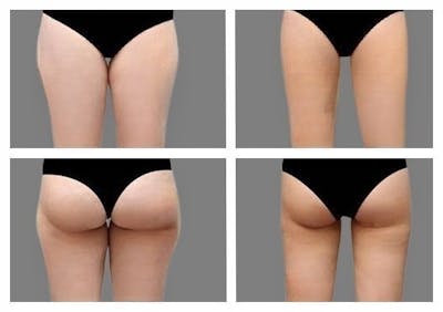 Liposuction Before & After Gallery - Patient 266648 - Image 1