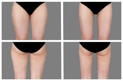 Liposuction Before & After Gallery - Patient 171634 - Image 1