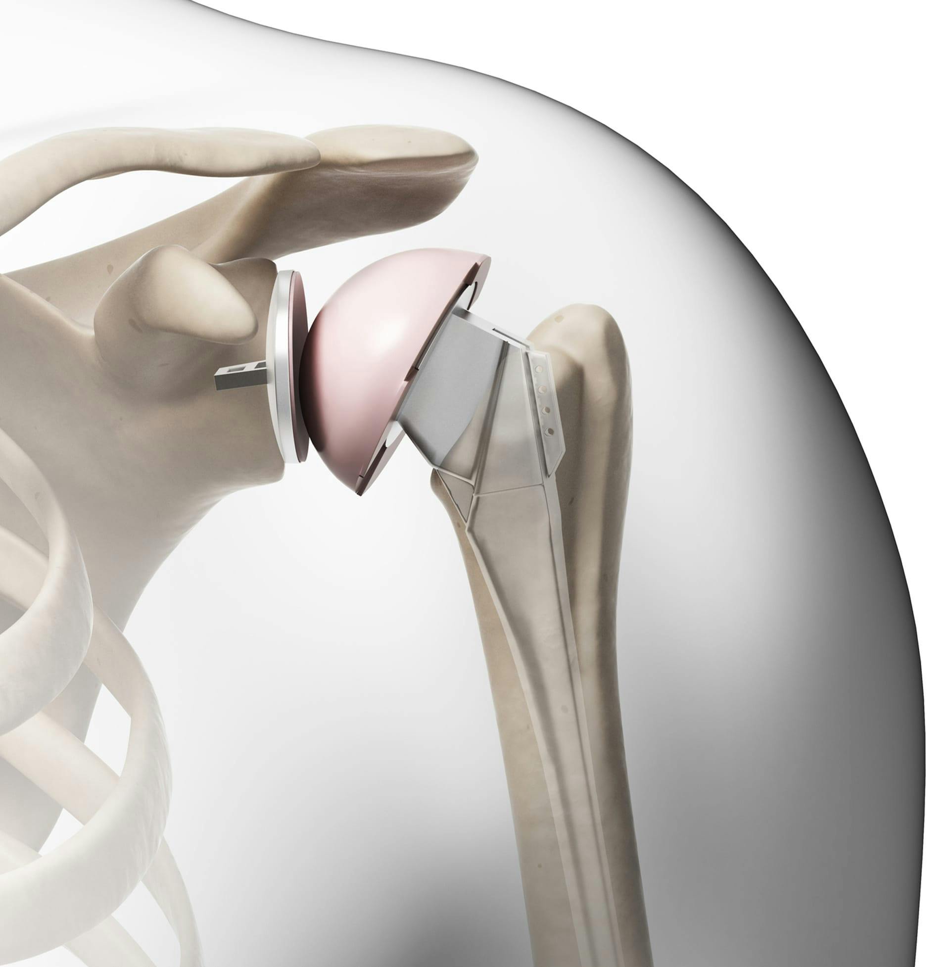 3d Animated xray image of of a shoulder after joint replacement
