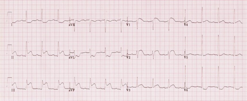 Cover Image for ROSC, hypotension and an ECG exigency