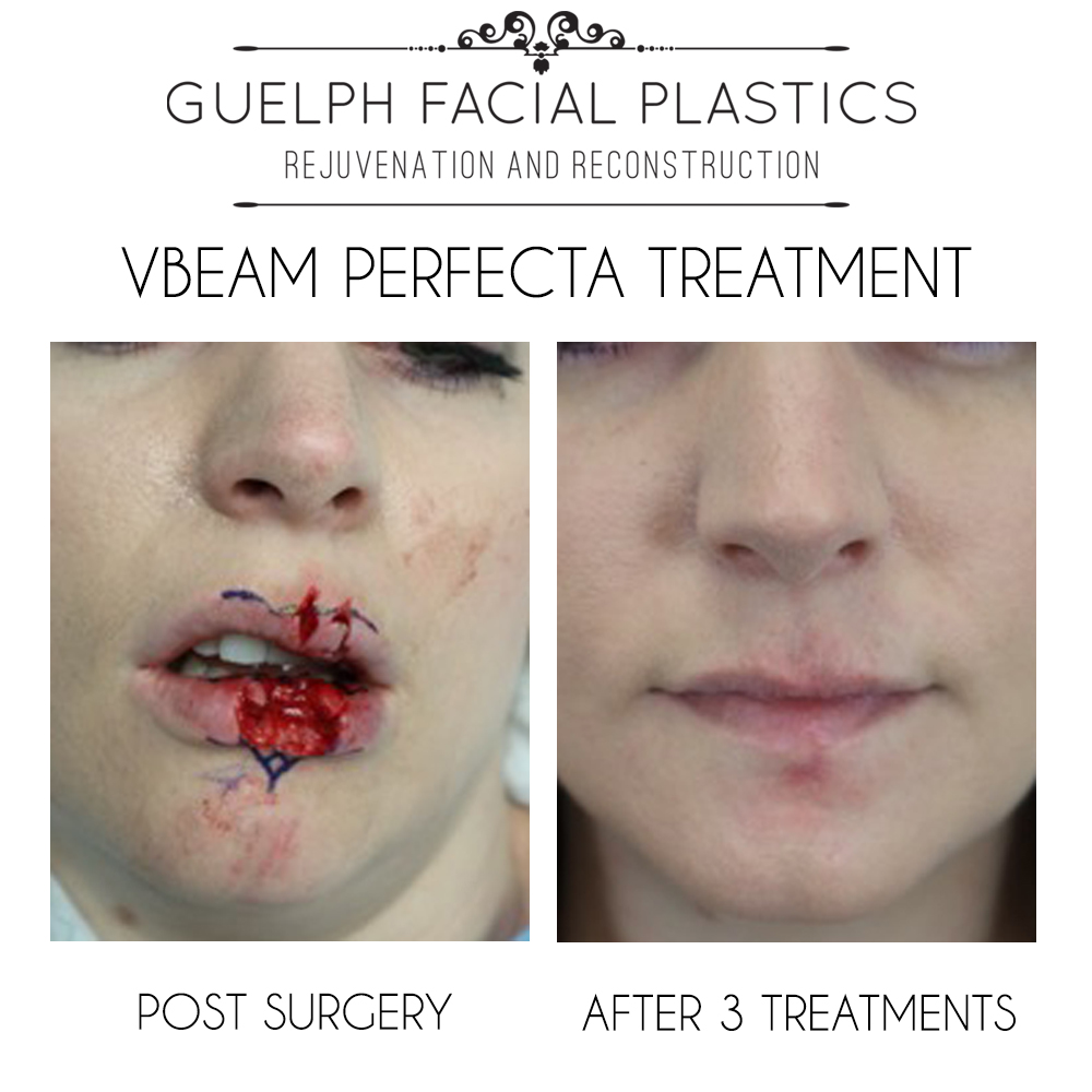 VBeam Perfecta Success Story - Guelph Facial Plastics