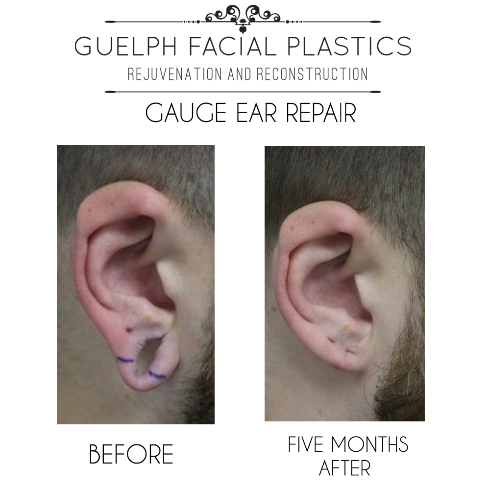 Ear Lobule Tear - Ear Surgeon