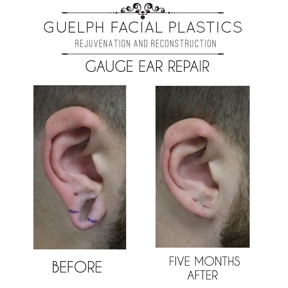 The Ear Gauge Fix Facial Reconstructive Surgery Guelph Facial Plastics