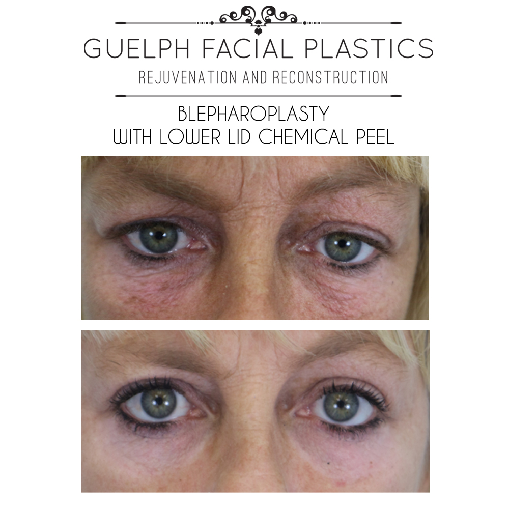 Renew Your Skin: Chemical Peels | Guelph Facial Plastics
