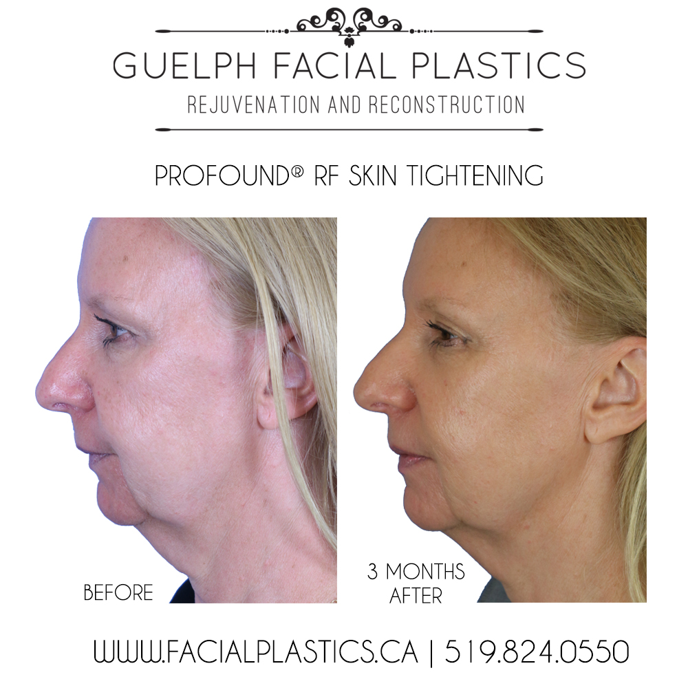 The Non-Surgical Facelift | Profound RF | Guelph Facial Plastics
