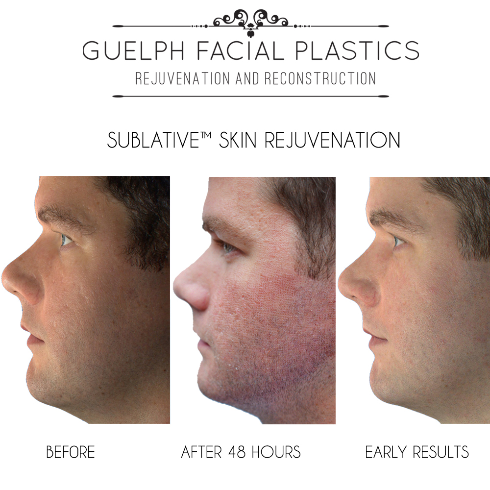 Before and After Sublative Skin Rejuvenation and Sublime Skin Tightening