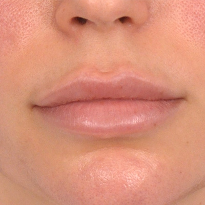 Patient 163834827 | Lip Lift Before & After Photos | Guelph Facial