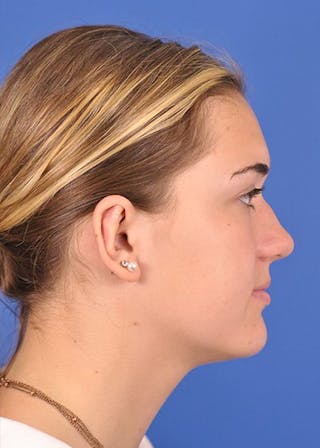 right side-after