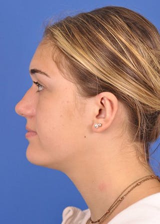 left side-after