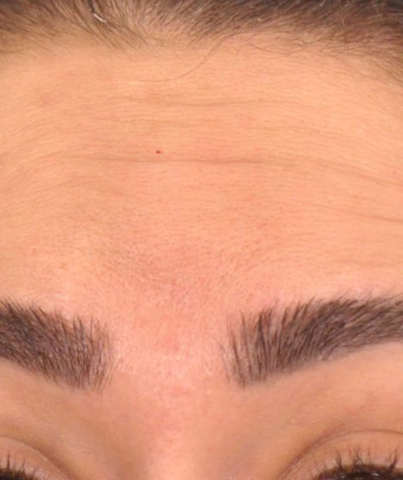 brows up-before