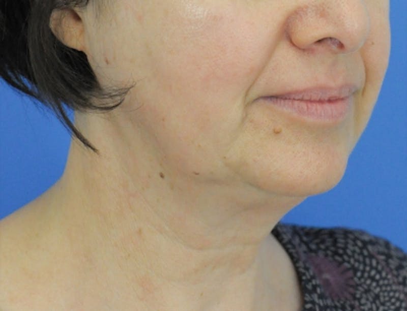 Profound Laser Before & After Gallery - Patient 163843175 - Image 5