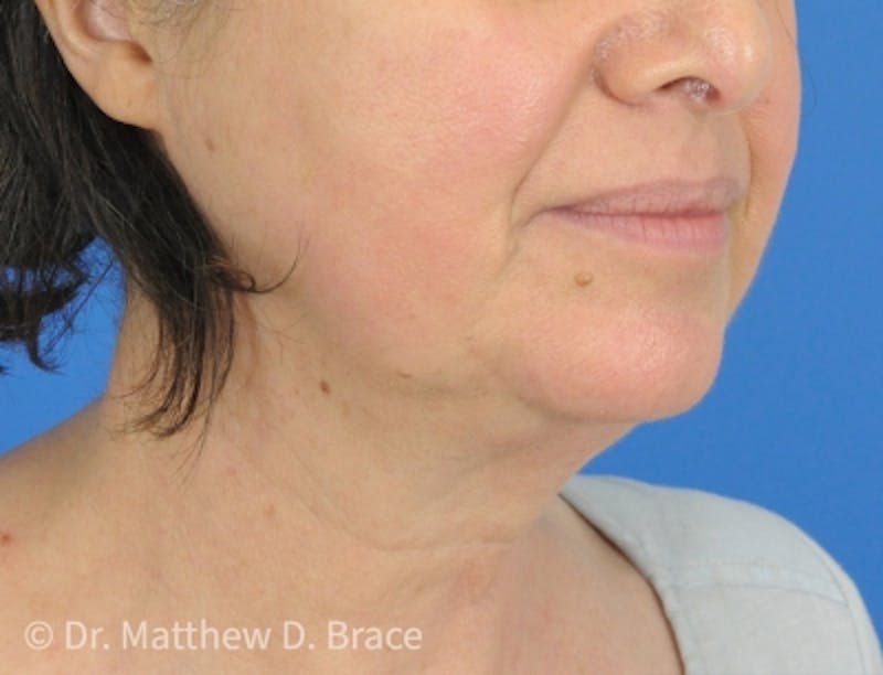 Profound Laser Before & After Gallery - Patient 163843175 - Image 6