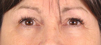 Brow Lift Before & After Gallery - Patient 165469852 - Image 1