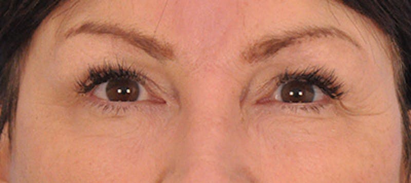Brow Lift Before & After Gallery - Patient 165469852 - Image 2