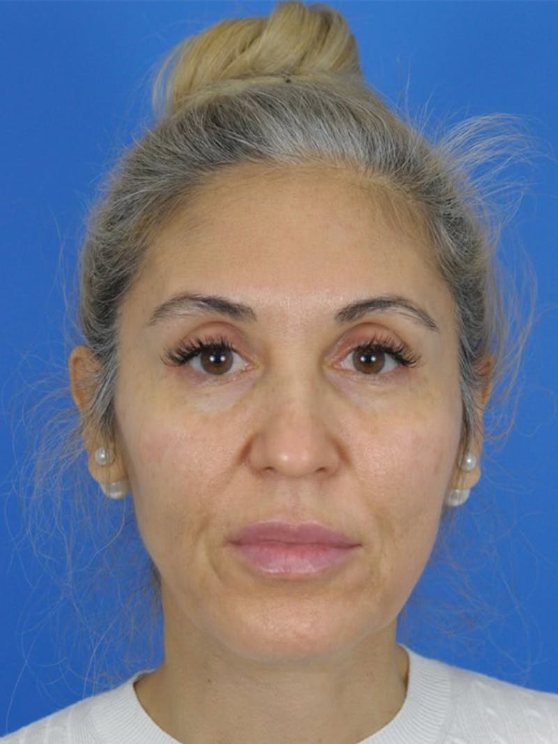 Facelift Before & After Gallery - Patient 165470807 - Image 1