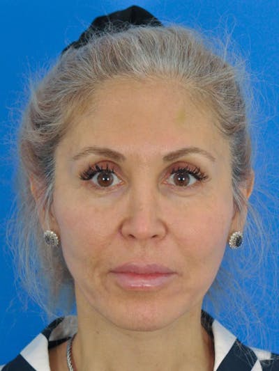 Facelift Before & After Gallery - Patient 165470807 - Image 2