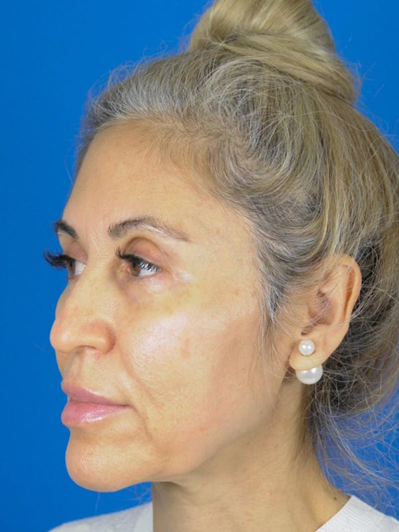 Facelift Before & After Gallery - Patient 165470807 - Image 3