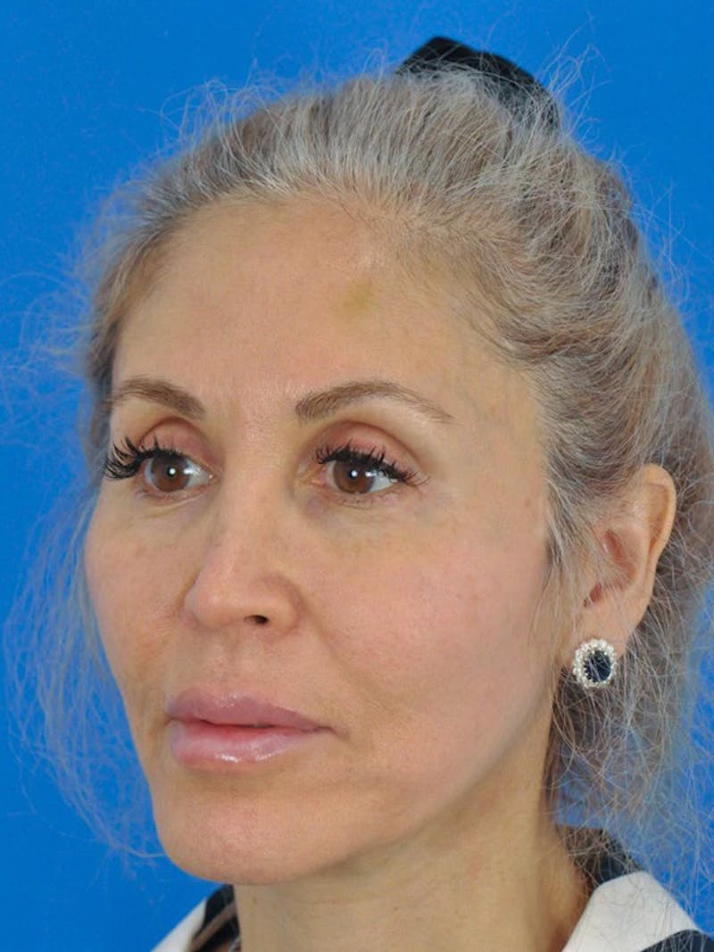 Facelift Before & After Gallery - Patient 165470807 - Image 4