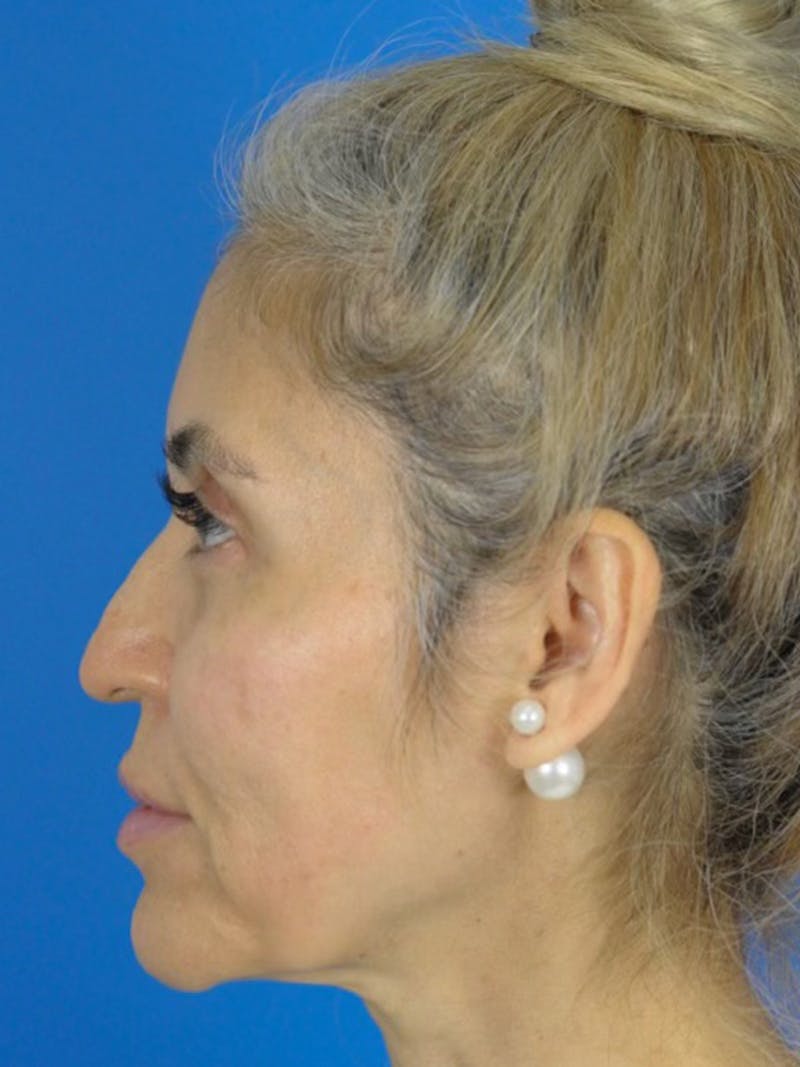 Rhinoplasty Before & After Gallery - Patient 165470806 - Image 1
