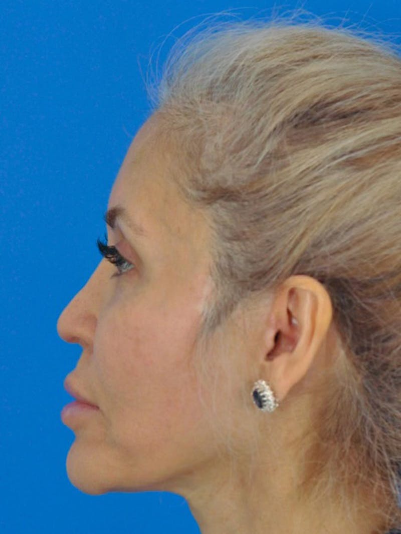 Facelift Before & After Gallery - Patient 165470807 - Image 6