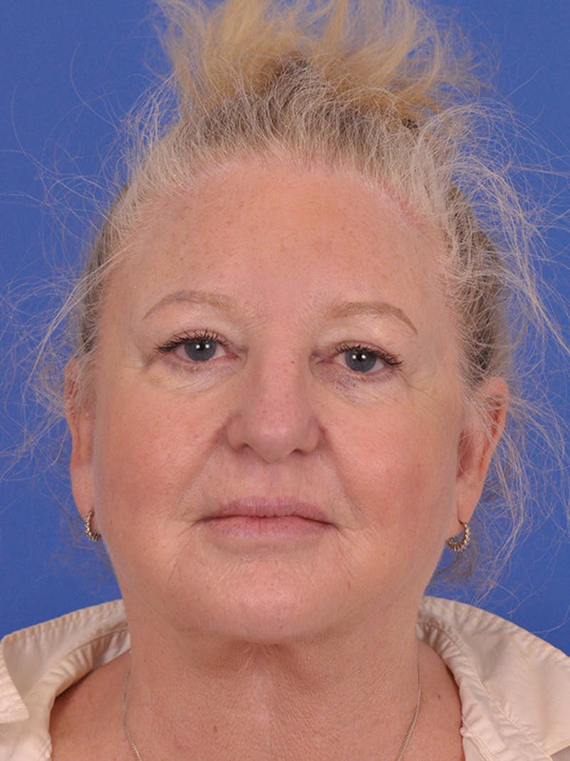 Facelift Before & After Gallery - Patient 165534110 - Image 1