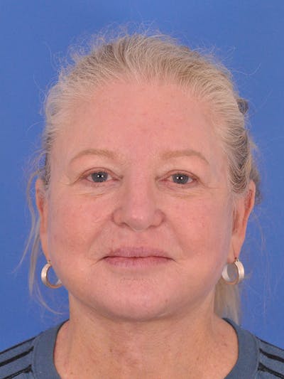 Facelift Before & After Gallery - Patient 165534110 - Image 2