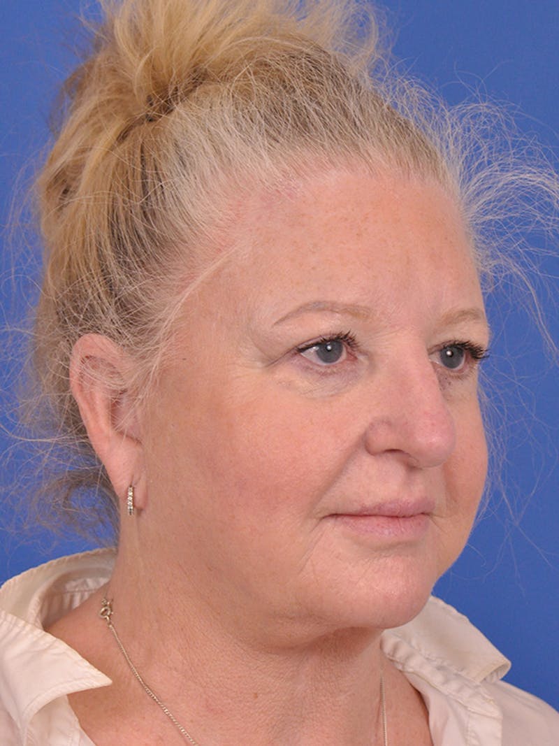 Facelift Before & After Gallery - Patient 165534110 - Image 3