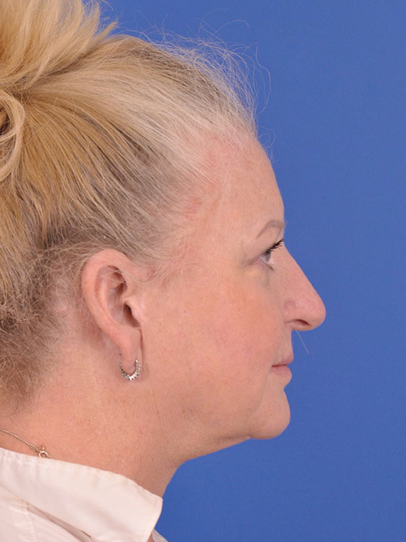 Facelift Before & After Gallery - Patient 165534110 - Image 5