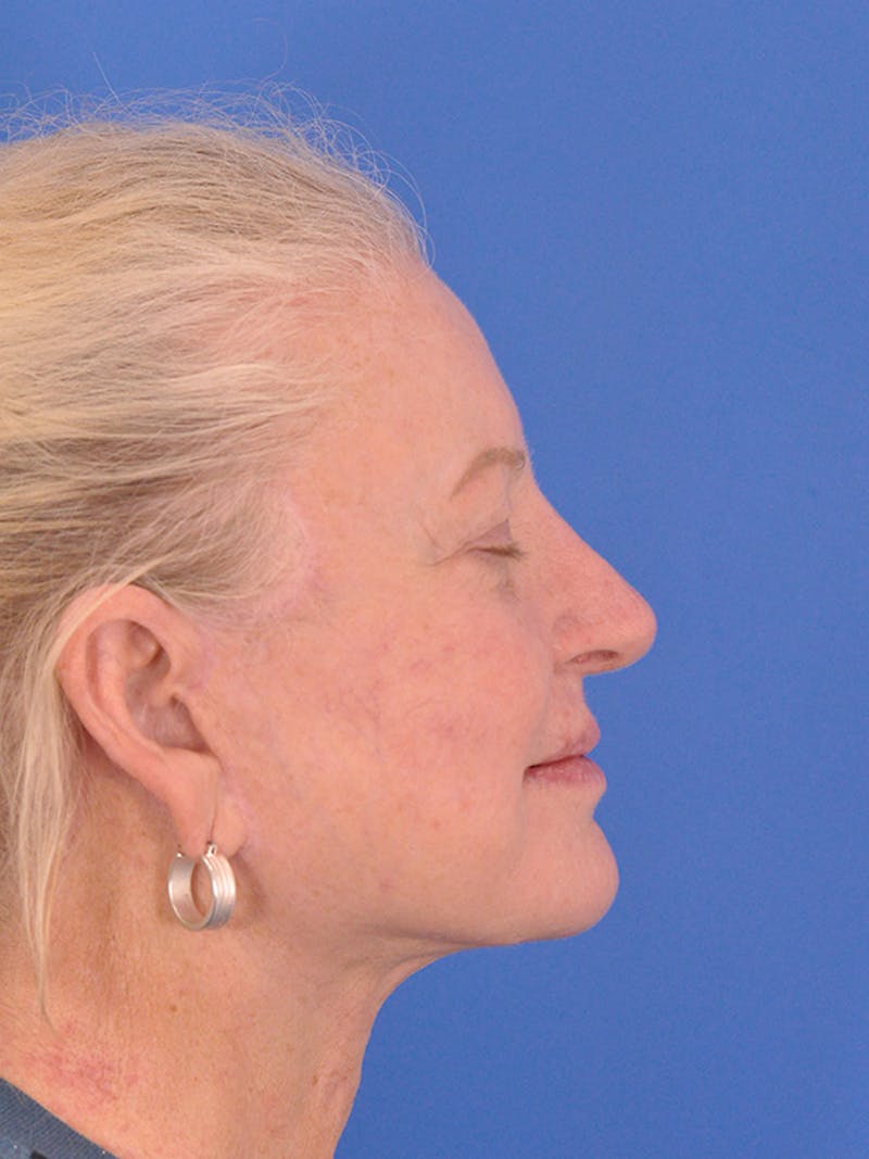 Facelift Before & After Gallery - Patient 165534110 - Image 6