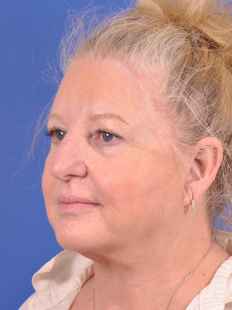 Facelift Before & After Gallery - Patient 165534110 - Image 7