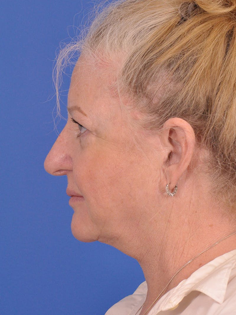 Facelift Before & After Gallery - Patient 165534110 - Image 9