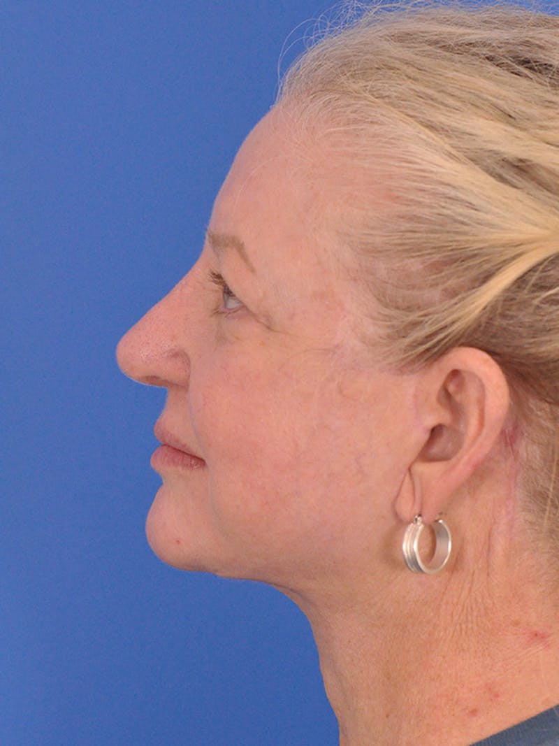 Facelift Before & After Gallery - Patient 165534110 - Image 10