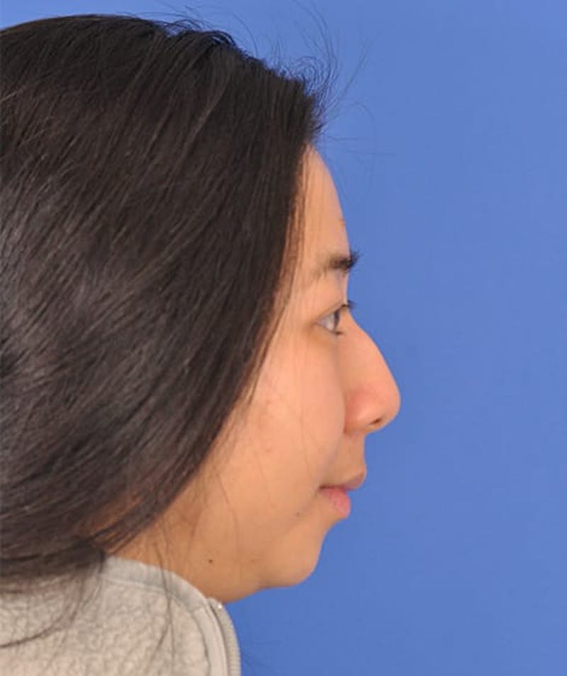 Rhinoplasty Before & After Gallery - Patient 166205940 - Image 1