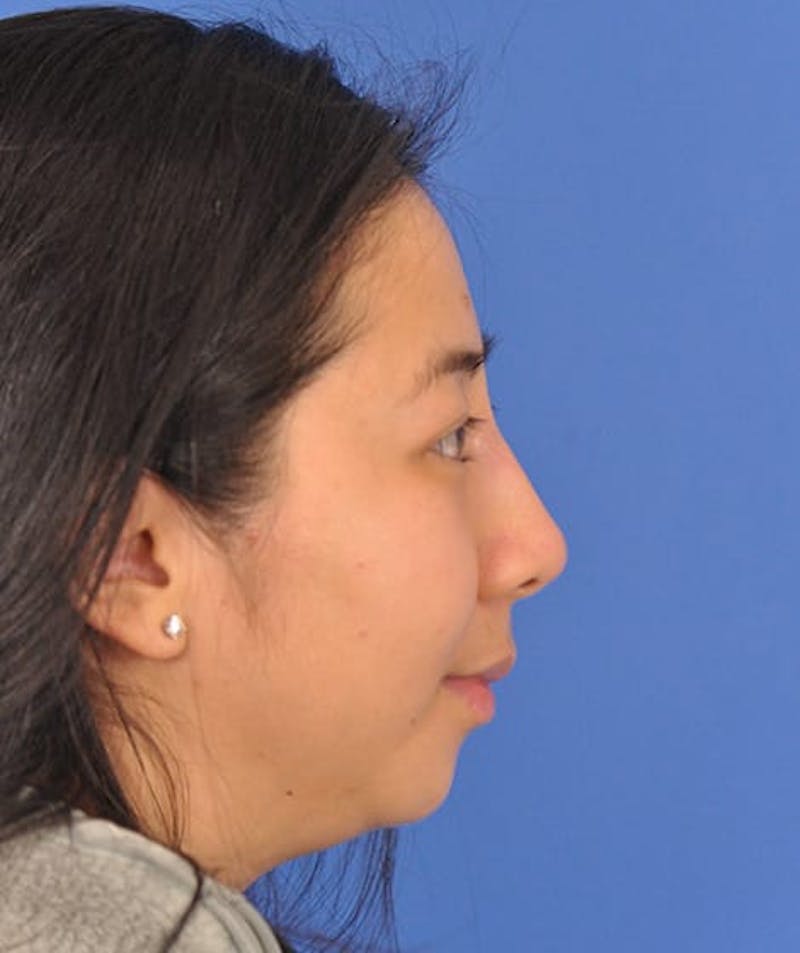 Rhinoplasty Before & After Gallery - Patient 166205940 - Image 2