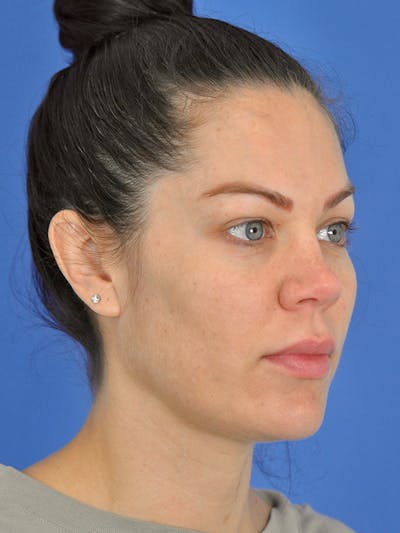 Profound Laser Before & After Gallery - Patient 166376838 - Image 1