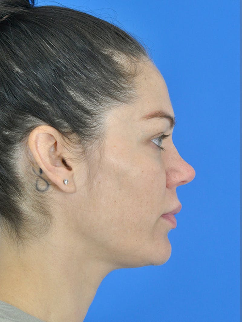 Profound Laser Before & After Gallery - Patient 166376838 - Image 3