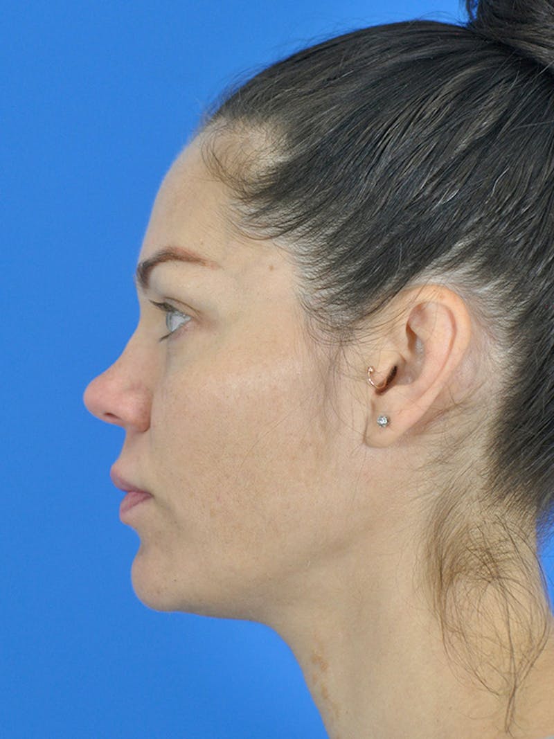 Profound Laser Before & After Gallery - Patient 166376838 - Image 5