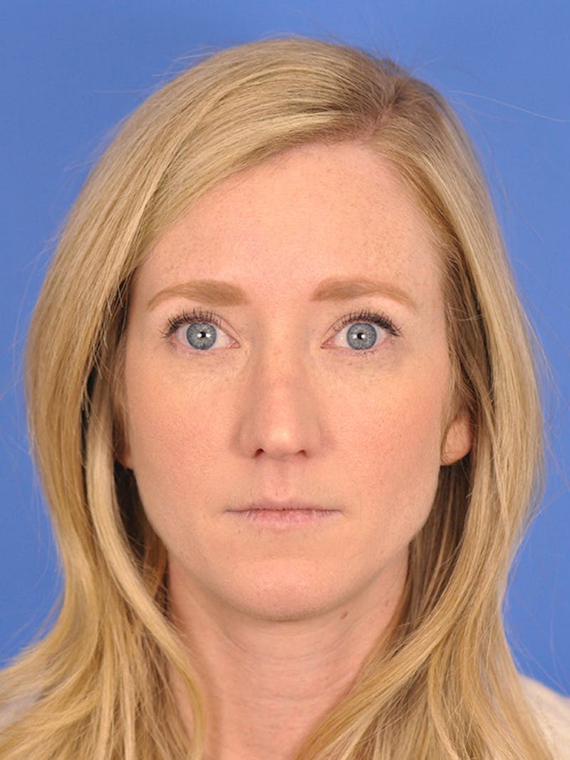 Rhinoplasty Before & After Gallery - Patient 166724988 - Image 3