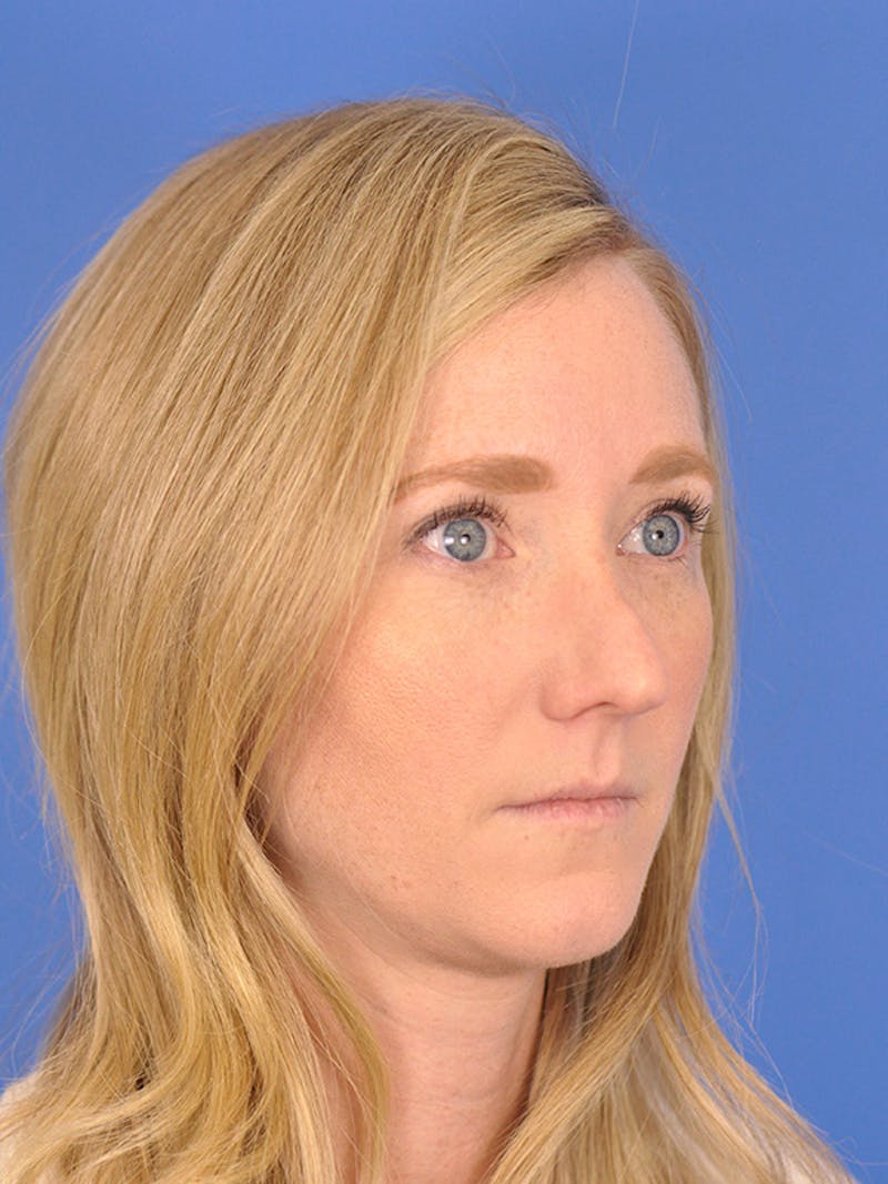 Rhinoplasty Before & After Gallery - Patient 166724988 - Image 5