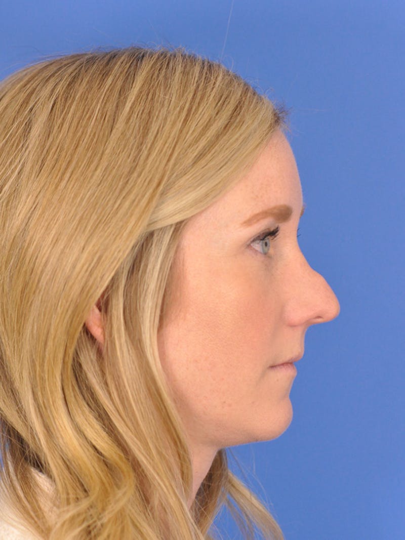 Rhinoplasty Before & After Gallery - Patient 166724988 - Image 1