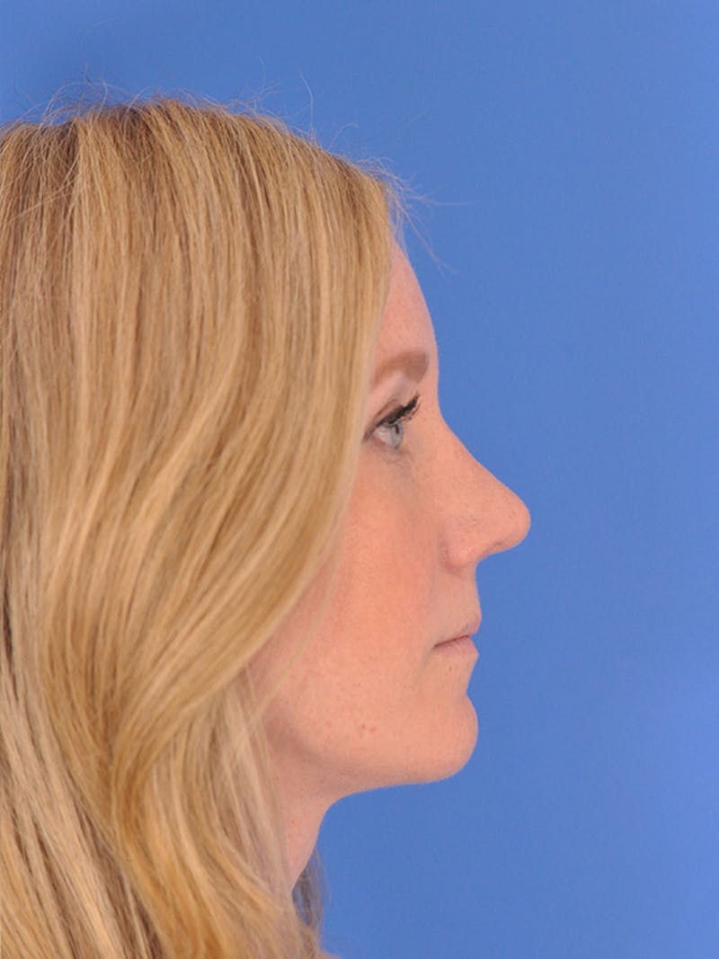 Rhinoplasty Before & After Gallery - Patient 166724988 - Image 2