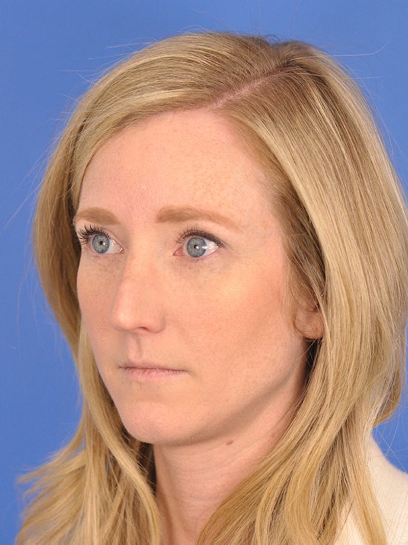 Rhinoplasty Before & After Gallery - Patient 166724988 - Image 7
