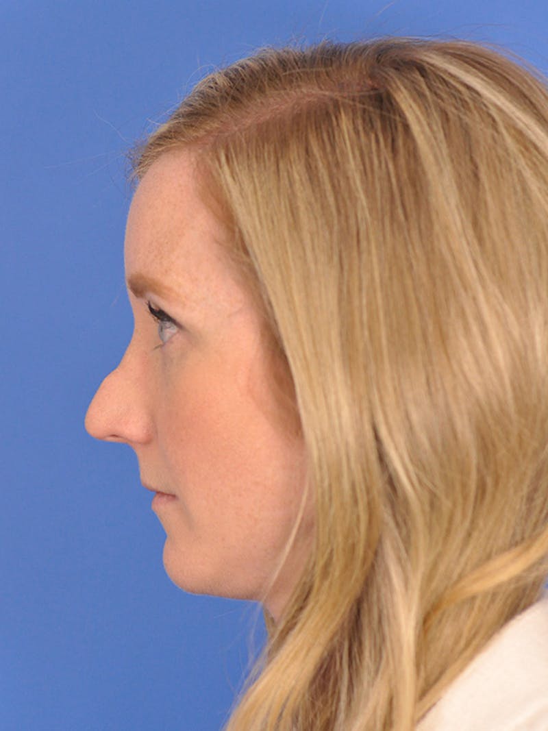 Rhinoplasty Before & After Gallery - Patient 166724988 - Image 9