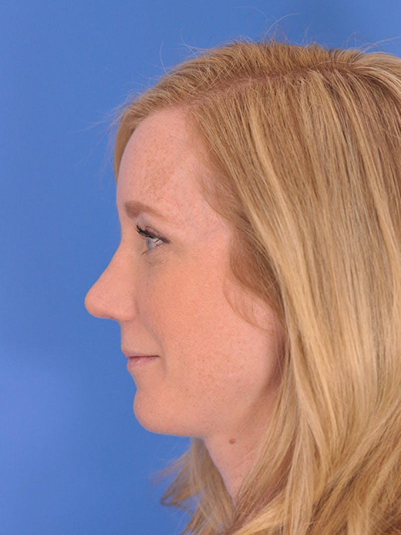 Rhinoplasty Before & After Gallery - Patient 166724988 - Image 10