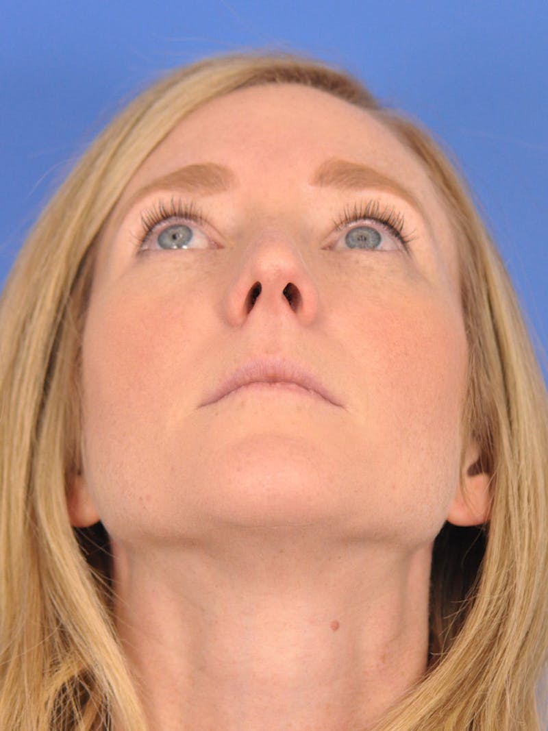 Rhinoplasty Before & After Gallery - Patient 166724988 - Image 11